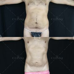 Pre y postoperatorio de una liposucción VASER de abdomen - Dr. Ignacio Genol