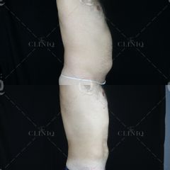 Pre y postoperatorio de una liposucción VASER de abdomen - Dr. Ignacio Genol