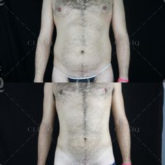 Pre y postoperatorio de una liposucción VASER de abdomen - Dr. Ignacio Genol