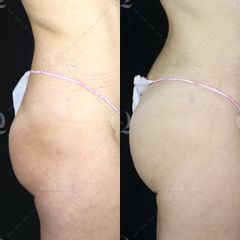Pre y postoperatorio de una liposucción VASER de glúteos - Dr. Ignacio Genol