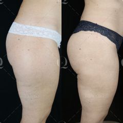Pre y postoperatorio de una liposucción VASER de glúteos - Dr. Ignacio Genol