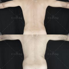 Pre y postoperatorio de una liposucción VASER de cintura