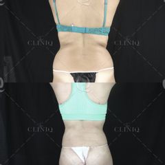 Pre y postoperatorio de una liposucción VASER de cintura - Dr. Ignacio Genol