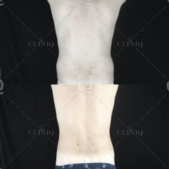 Pre y postoperatorio de una liposucción VASER de cintura - Dr. Ignacio Genol