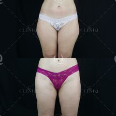 Pre y postoperatorio de una liposucción VASER de piernas - Dr. Ignacio Genol