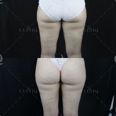 Pre y postoperatorio de una liposucción VASER de piernas - Dr. Ignacio Genol