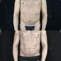 Pre y postoperatorio de una liposucción VASER HD - Dr. Ignacio Genol