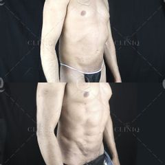 Pre y postoperatorio de una liposucción VASER HD - Dr. Ignacio Genol