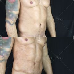 Pre y postoperatorio de una liposucción VASER HD