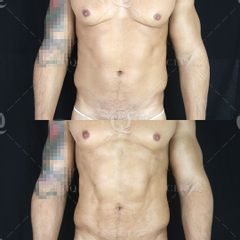 Pre y postoperatorio de una liposucción VASER HD - Dr. Ignacio Genol