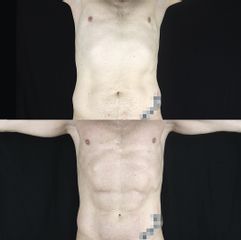 Pre y postoperatorio de una liposucción VASER HD - Dr. Ignacio Genol
