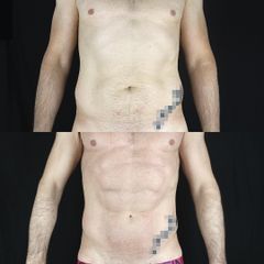 Pre y postoperatorio de una liposucción VASER HD
