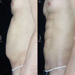Pre y postoperatorio de una liposucción VASER HD - Dr. Ignacio Genol