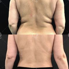 Pre y postoperatorio de Renuvion Jplasma - Dr. Ignacio Genol