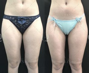 Pre y postoperatorio de Renuvion Jplasma - Dr. Ignacio Genol