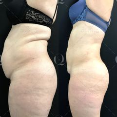Pre y postoperatorio de Renuvion Jplasma - Dr. Ignacio Genol