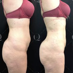 Pre y postoperatorio de Renuvion Jplasma - Dr. Ignacio Genol