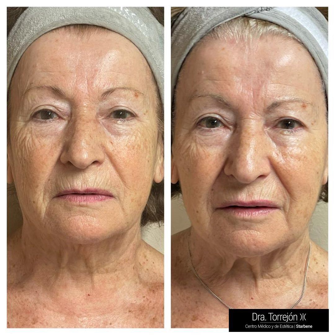 Radiofrecuencia facial Antes y después - Multiestetica.com