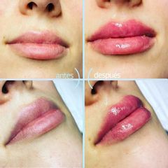 Aumento de labios - Dra. Carmen Torrejón