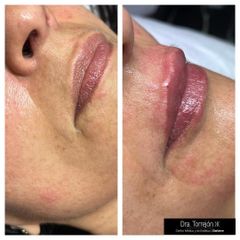 Aumento de labios - Dra. Carmen Torrejón