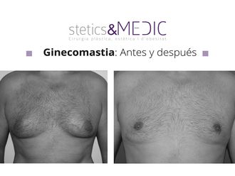 Ginecomastia - 649754