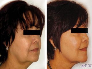 Antes y después Radiofrecuencia facial 
