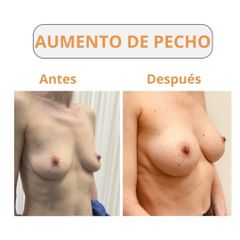 Aumento de pecho - Medics Integral Salut