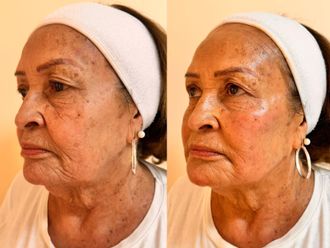 Lifting sin cirugía antes y después - 877313