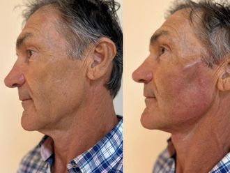 Lifting sin cirugía antes y después - 877314