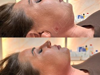 Lifting sin cirugía antes y después - 877318