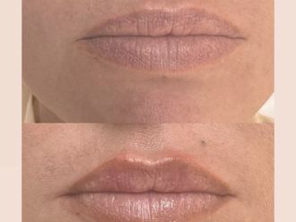 Aumento labios antes y después - 878294