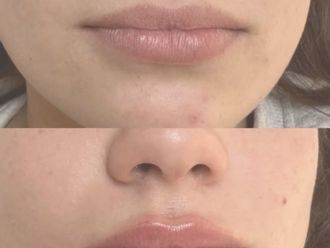 Aumento labios antes y después - 878295