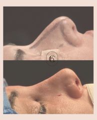 Kai Clinic - Rinoplastia