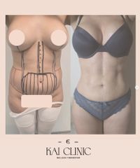 Kai Clinic - Lipoescultura