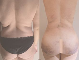 Lipofilling antes y después - 878299