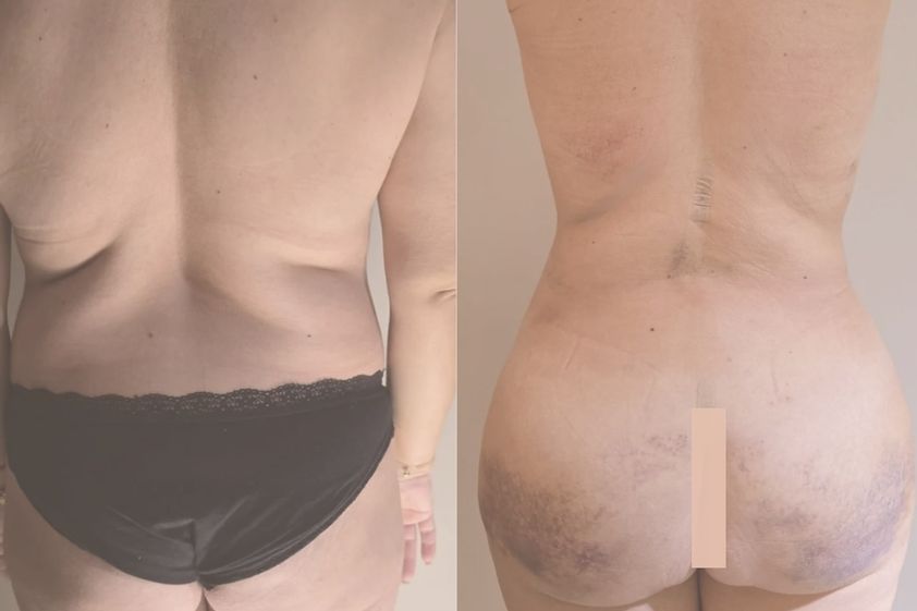 Lipofilling antes y después - 878299