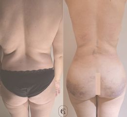Kai Clinic - Lipofilling