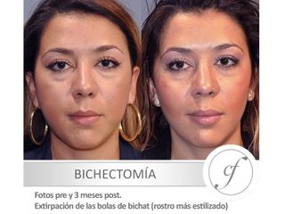 Antes y después Bichectomia