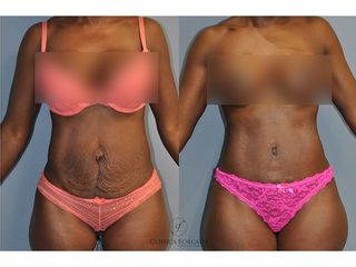 Antes y después Abdominoplastia