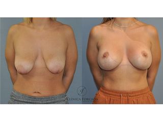 Antes y después mastopexia 