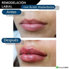 Aumento de labios - New York Clinica