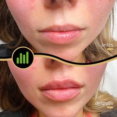 Aumento de labios - New York Clinica
