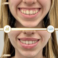 Sonrisa gingival + hidratación de labios - New York Clinic