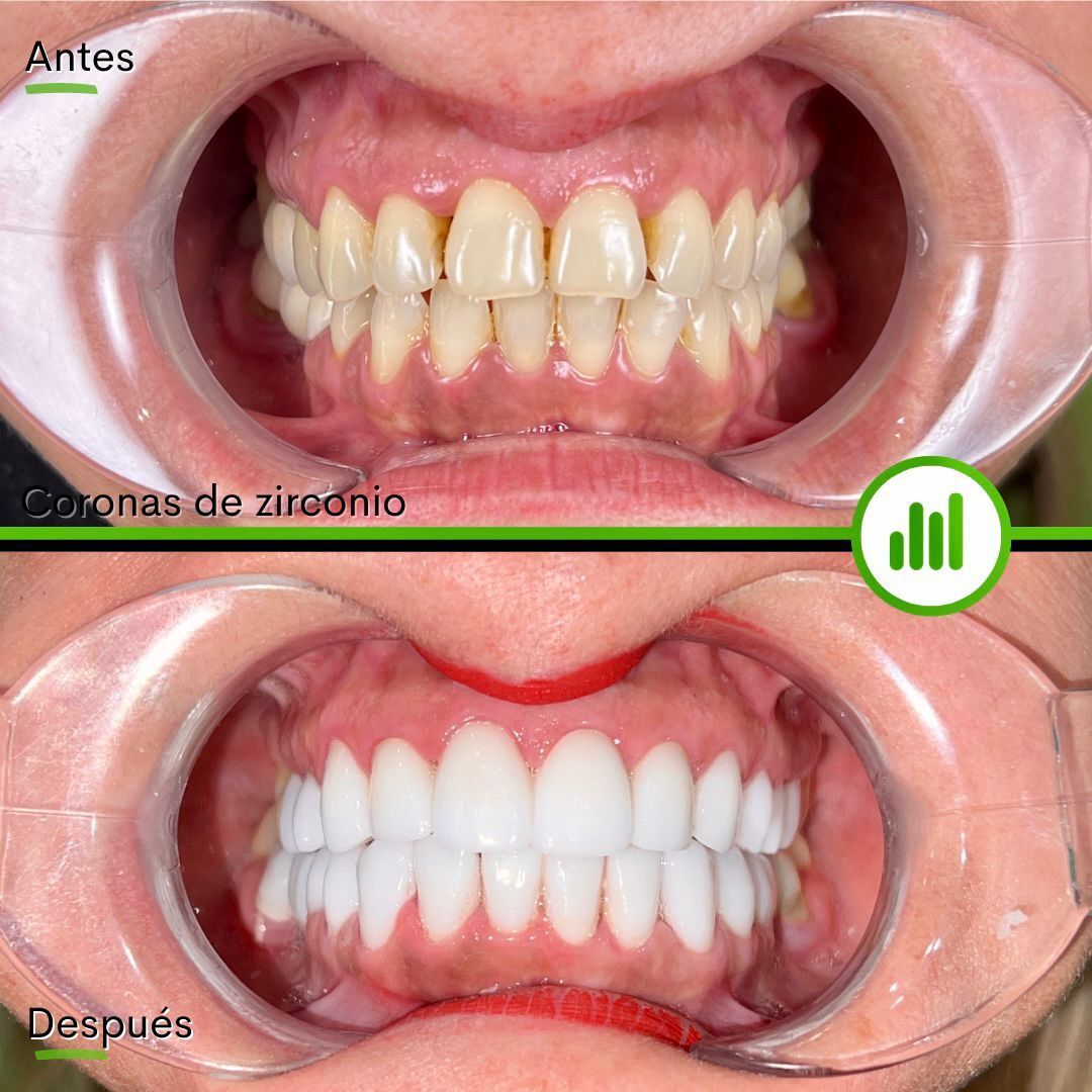 Carillas dentales Antes y después -  