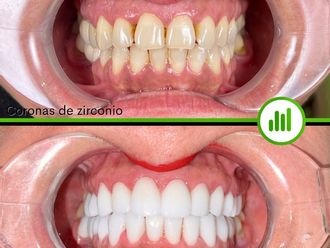 Carillas dentales - 848110