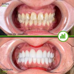 Carillas dentales - New York Clinica