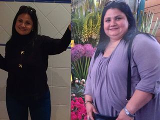 Antes y después Cirugia Obesidad