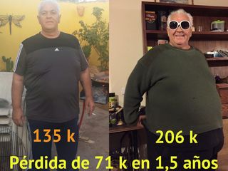 Antes y después Cirugia Obesidad