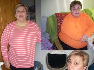 Antes y después Cirugia Obesidad