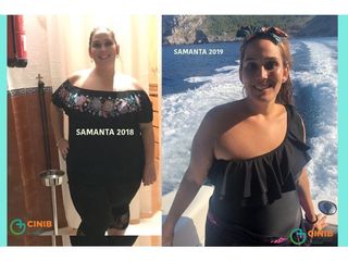 Antes y después Cirugía Obesidad